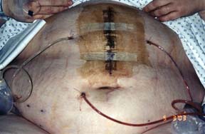 [photo of abdomen after surgery]