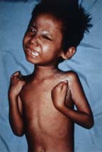 Child with tetanus seizuring
