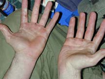 photo of blistered hands